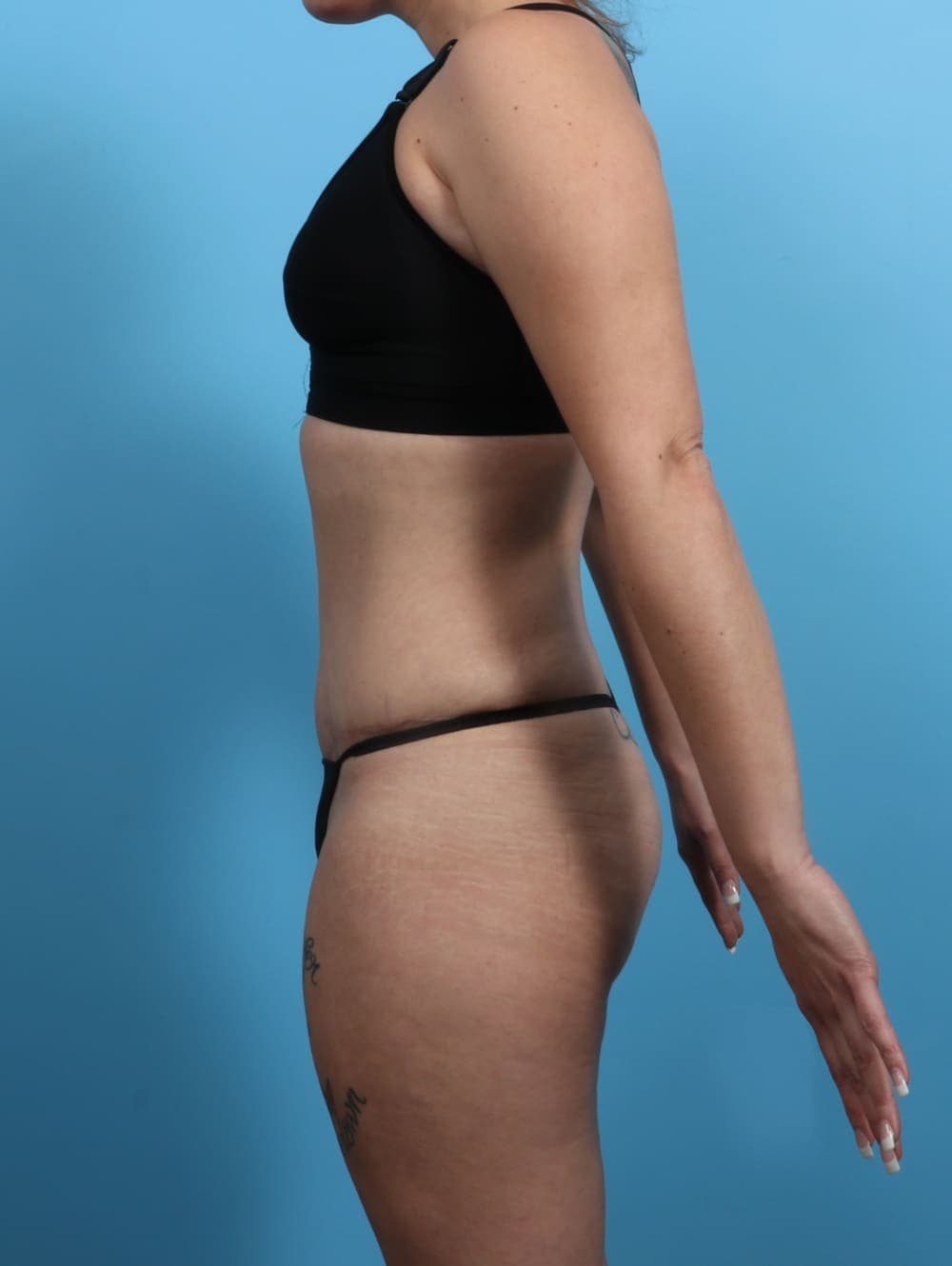 Tummy Tuck case #3193 after, image 4