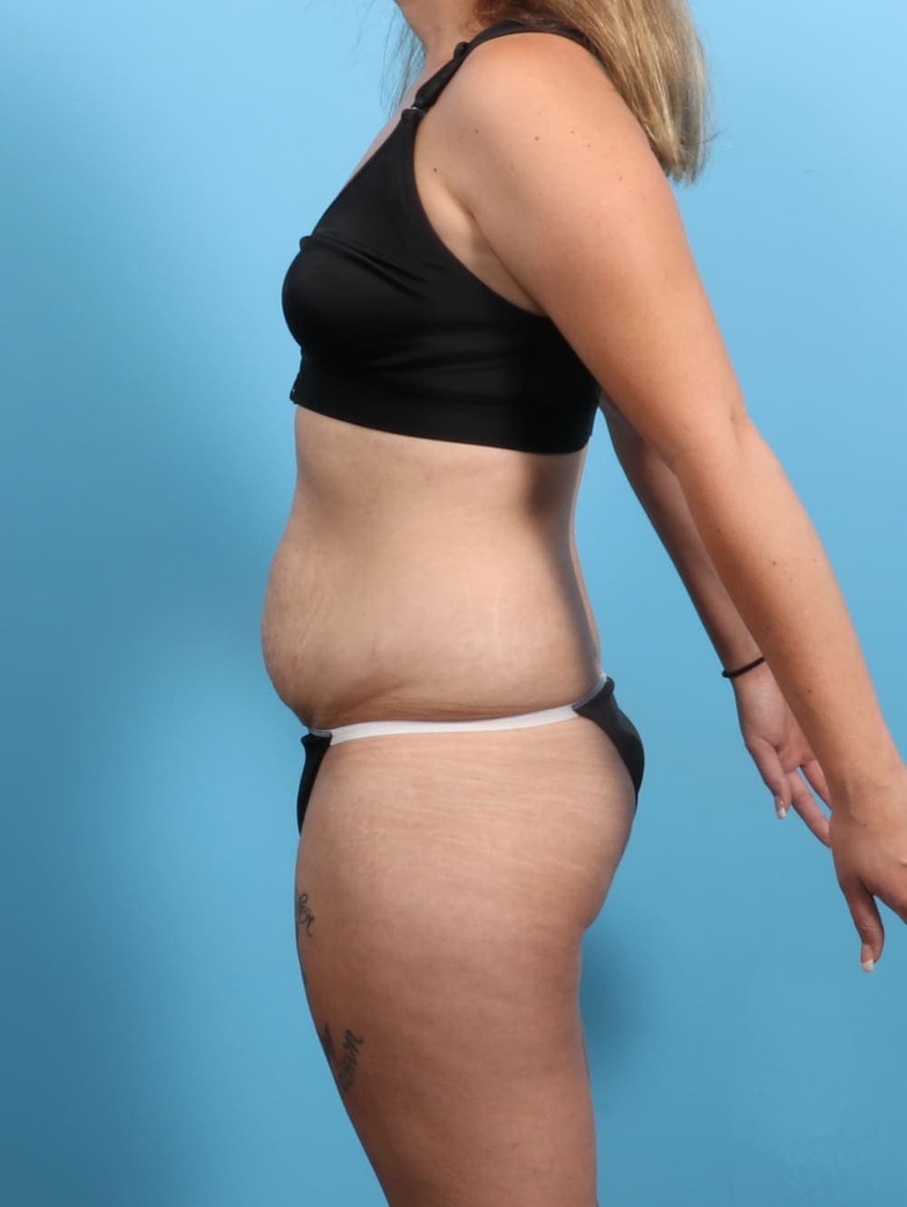 Tummy Tuck case #3193 before, image 4