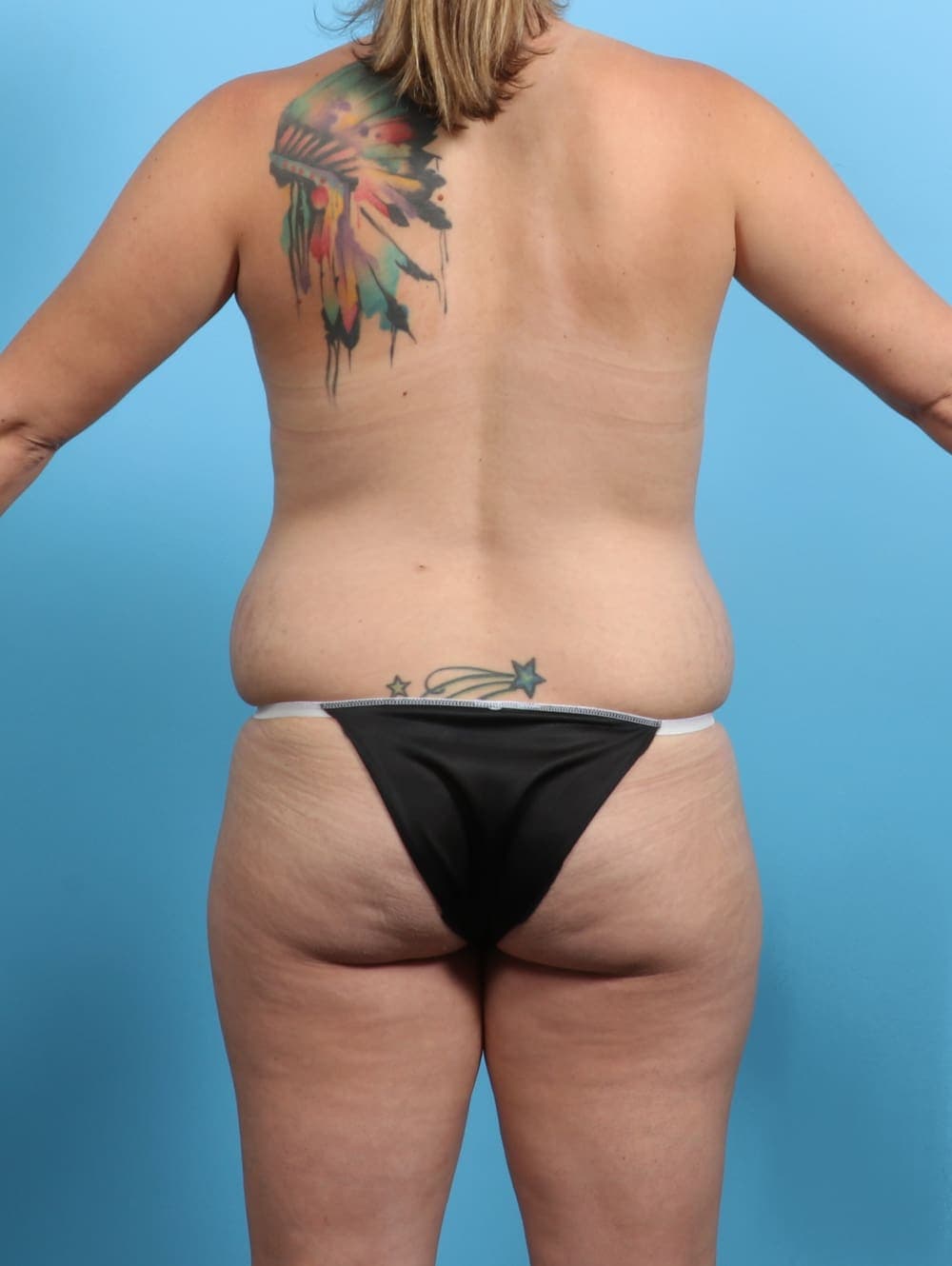 Tummy Tuck case #3193 before, image 2