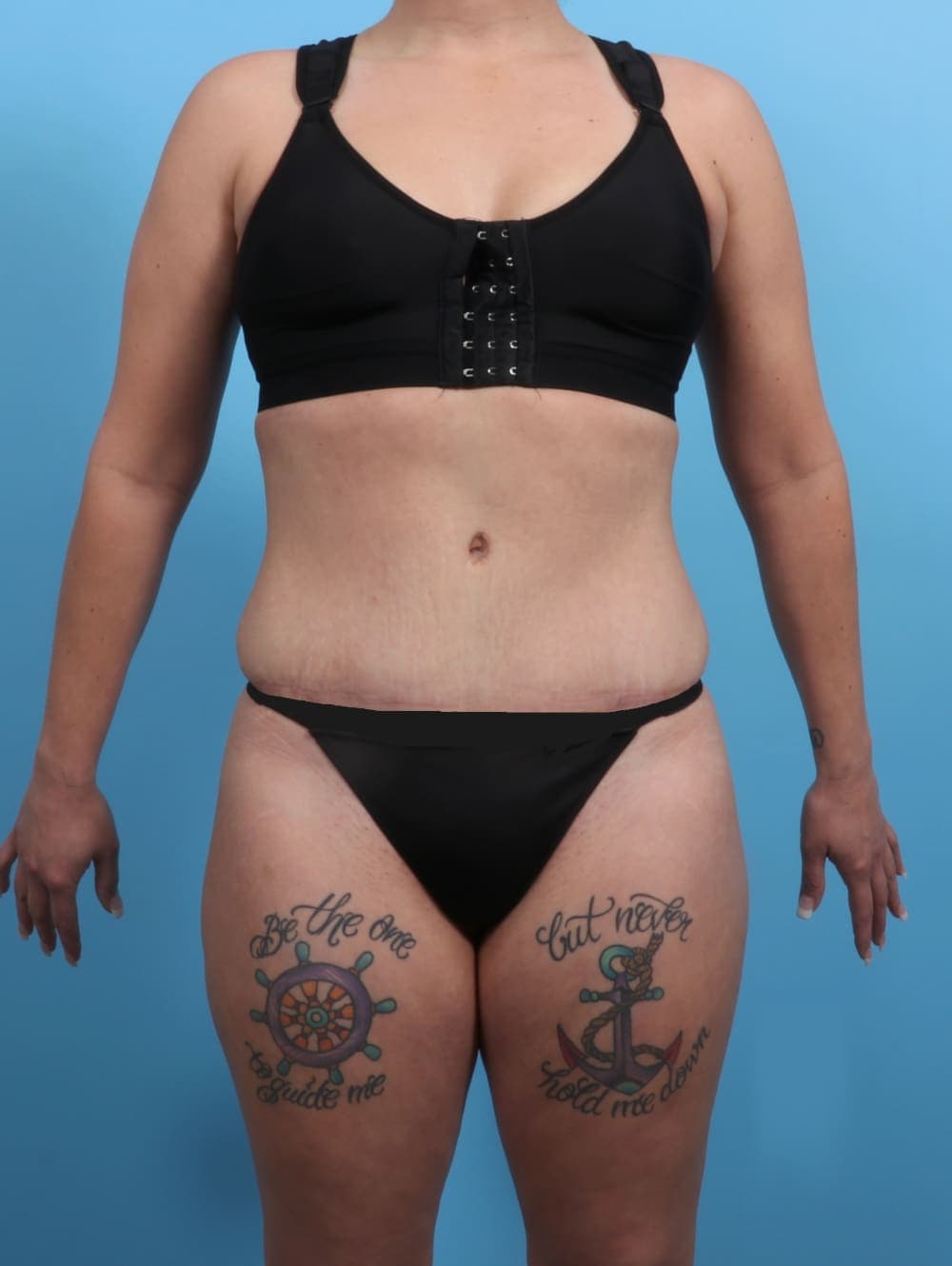 Tummy Tuck case #3193 after, image 1