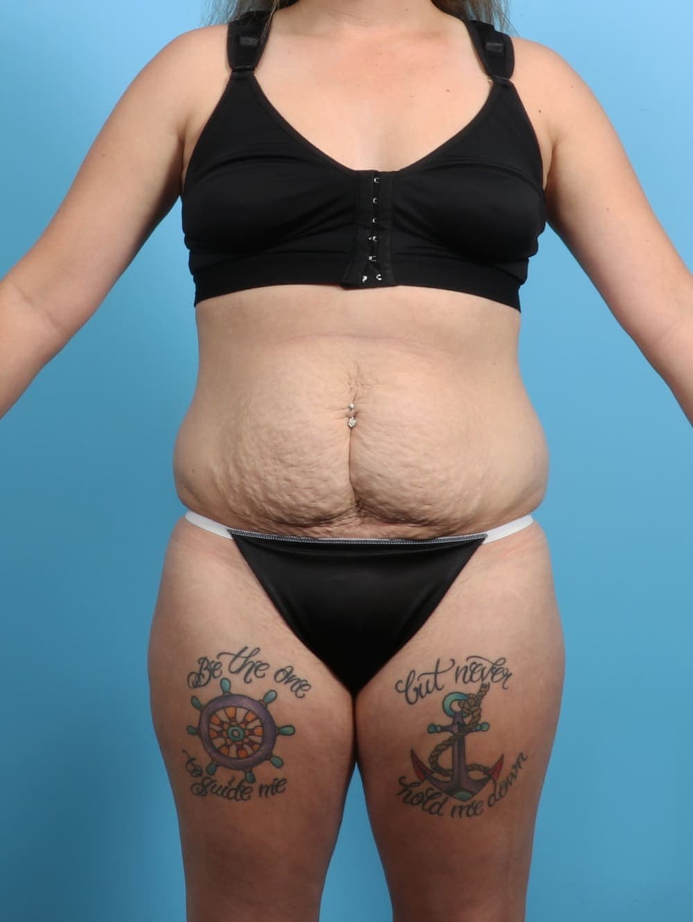 Tummy Tuck case #3193 before, image 1