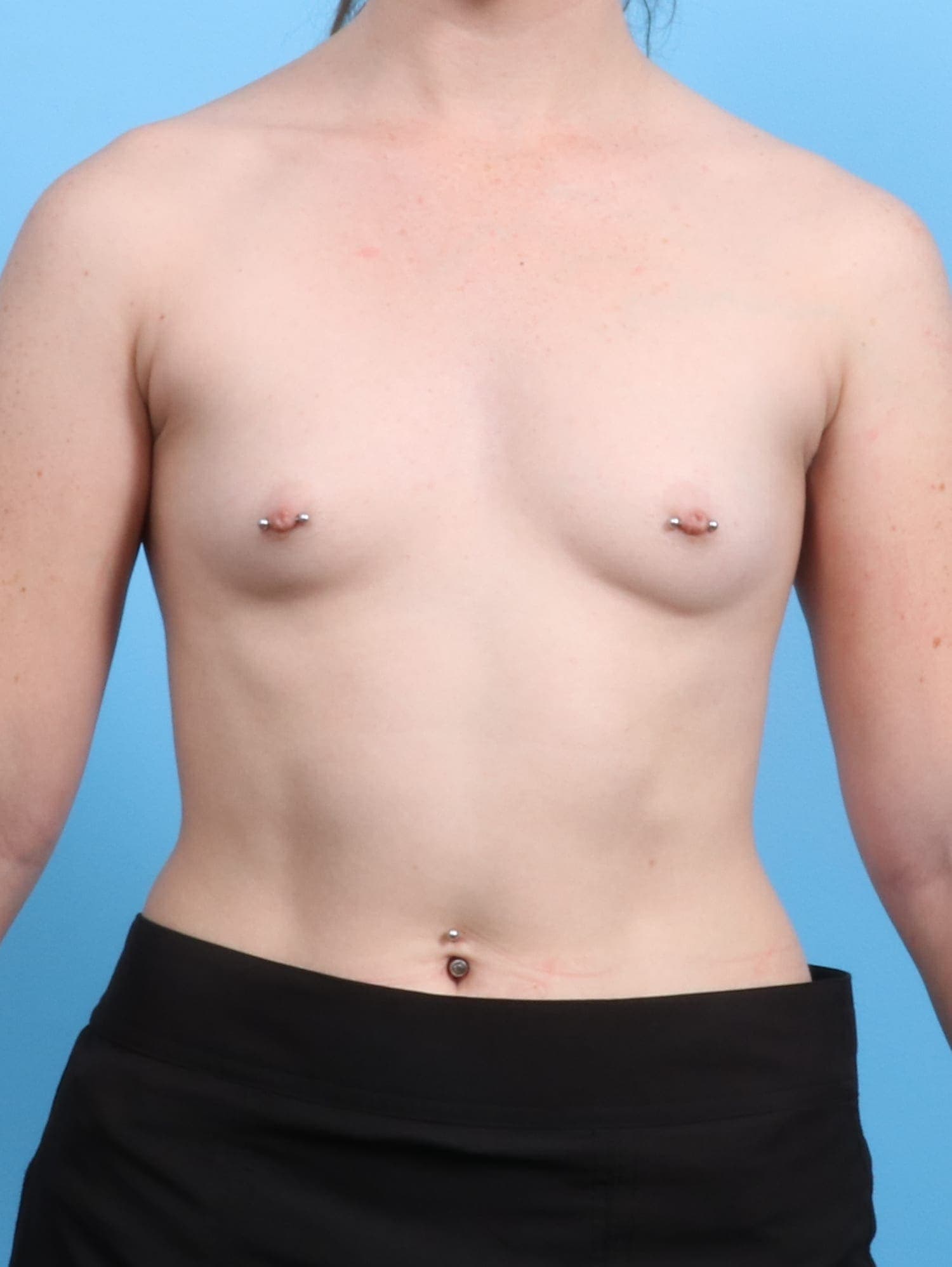 Breast Augmentation case #1667 before, image 1