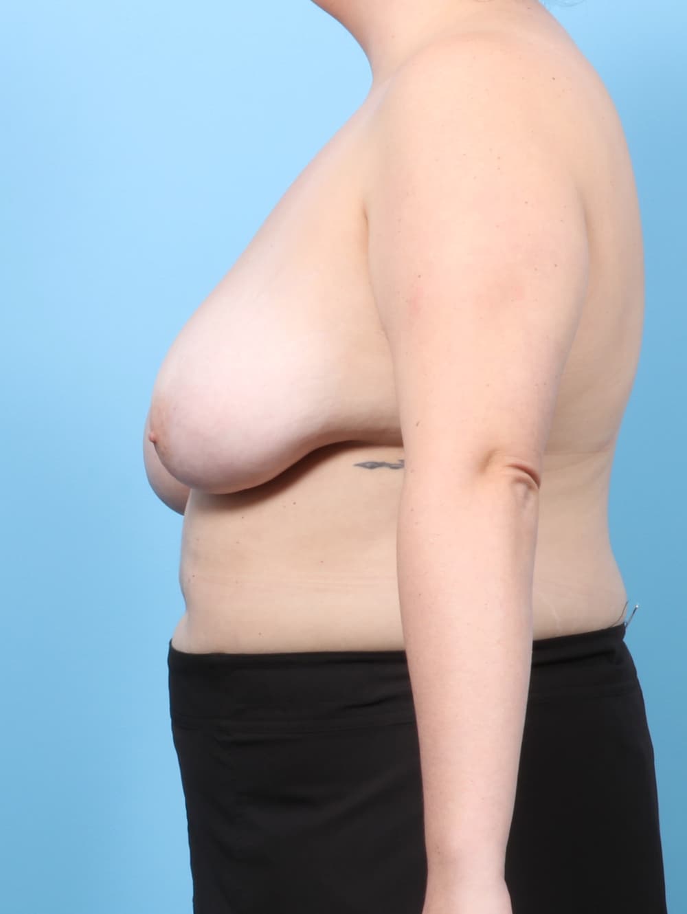 Breast Lift/Reduction case #8237 before, image 3