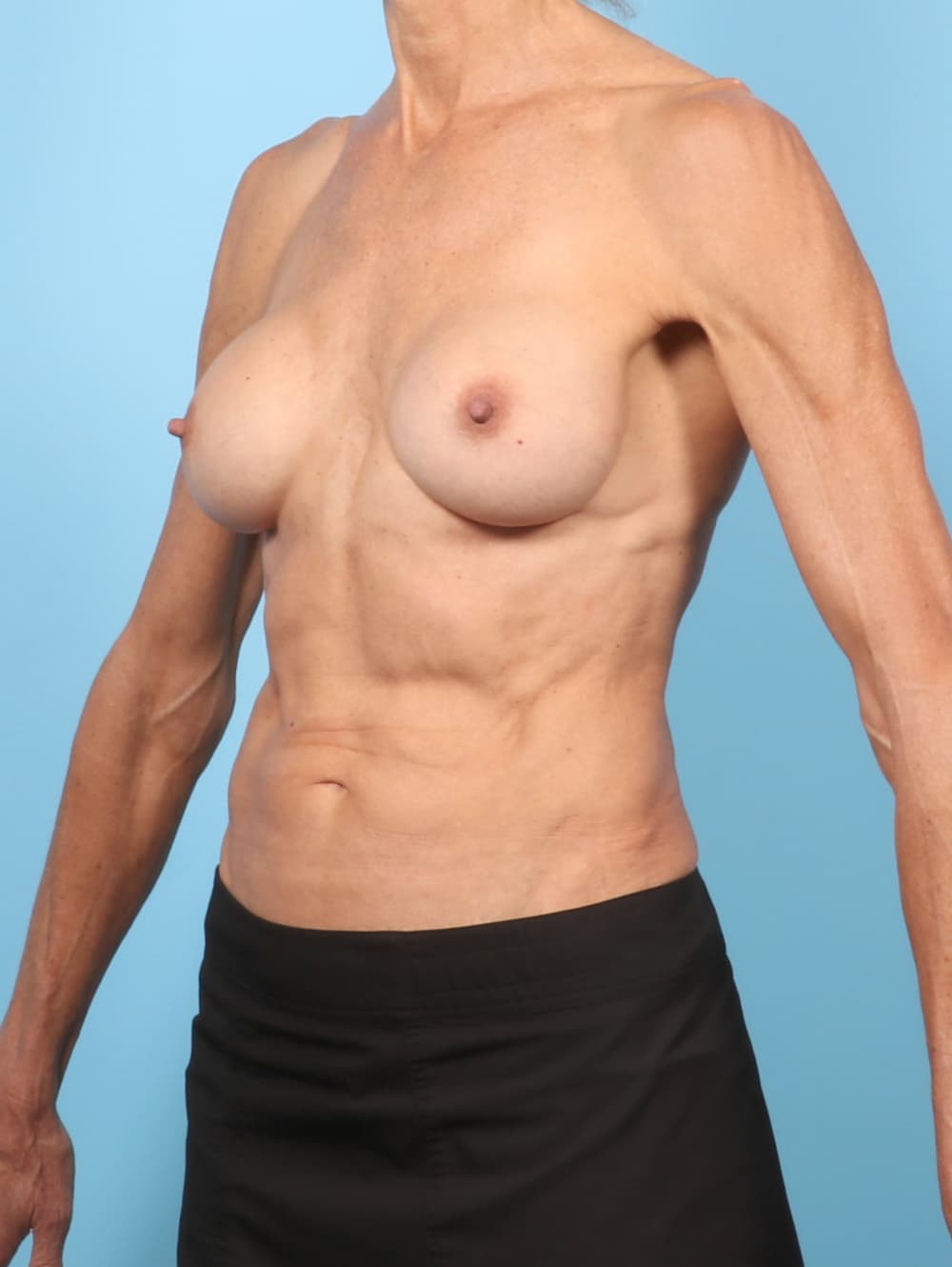 Breast Implant Revision case #8094 before, image 2