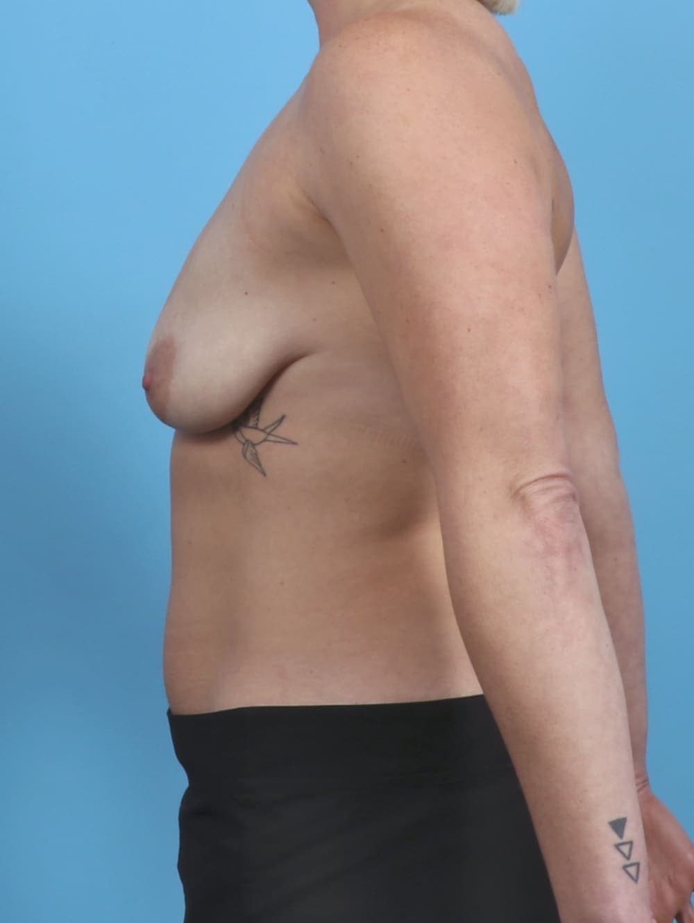 Breast Lift with Implants case #4027 before, image 3
