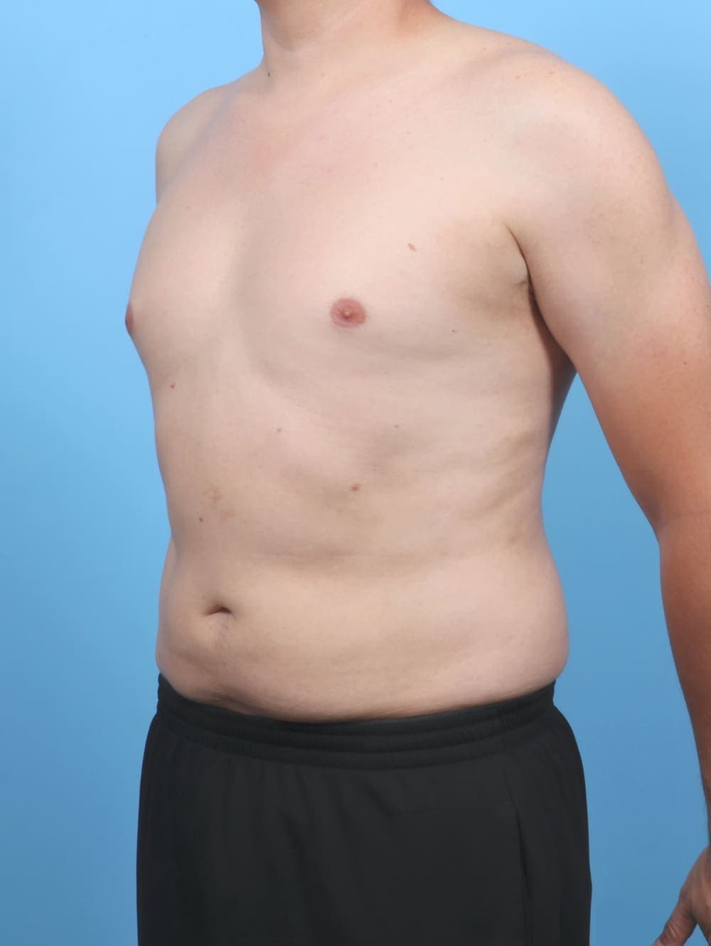 Liposuction case #5992 after, image 2