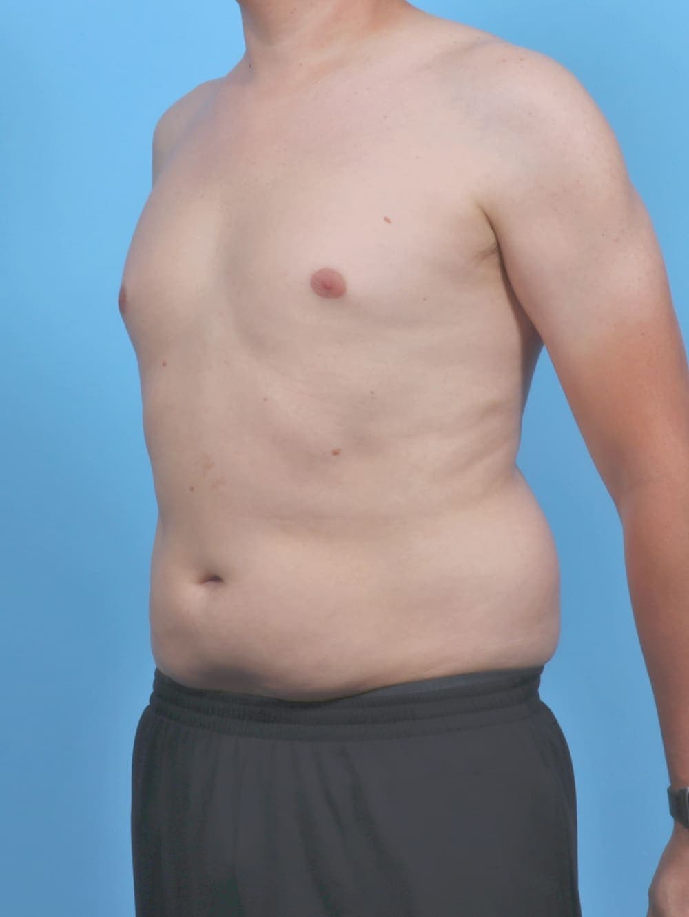 Liposuction case #5992 before, image 2