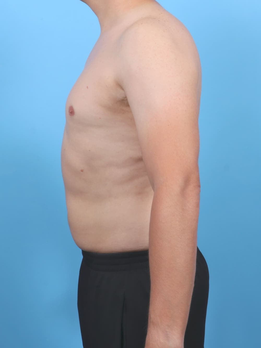Liposuction case #5992 after, image 3