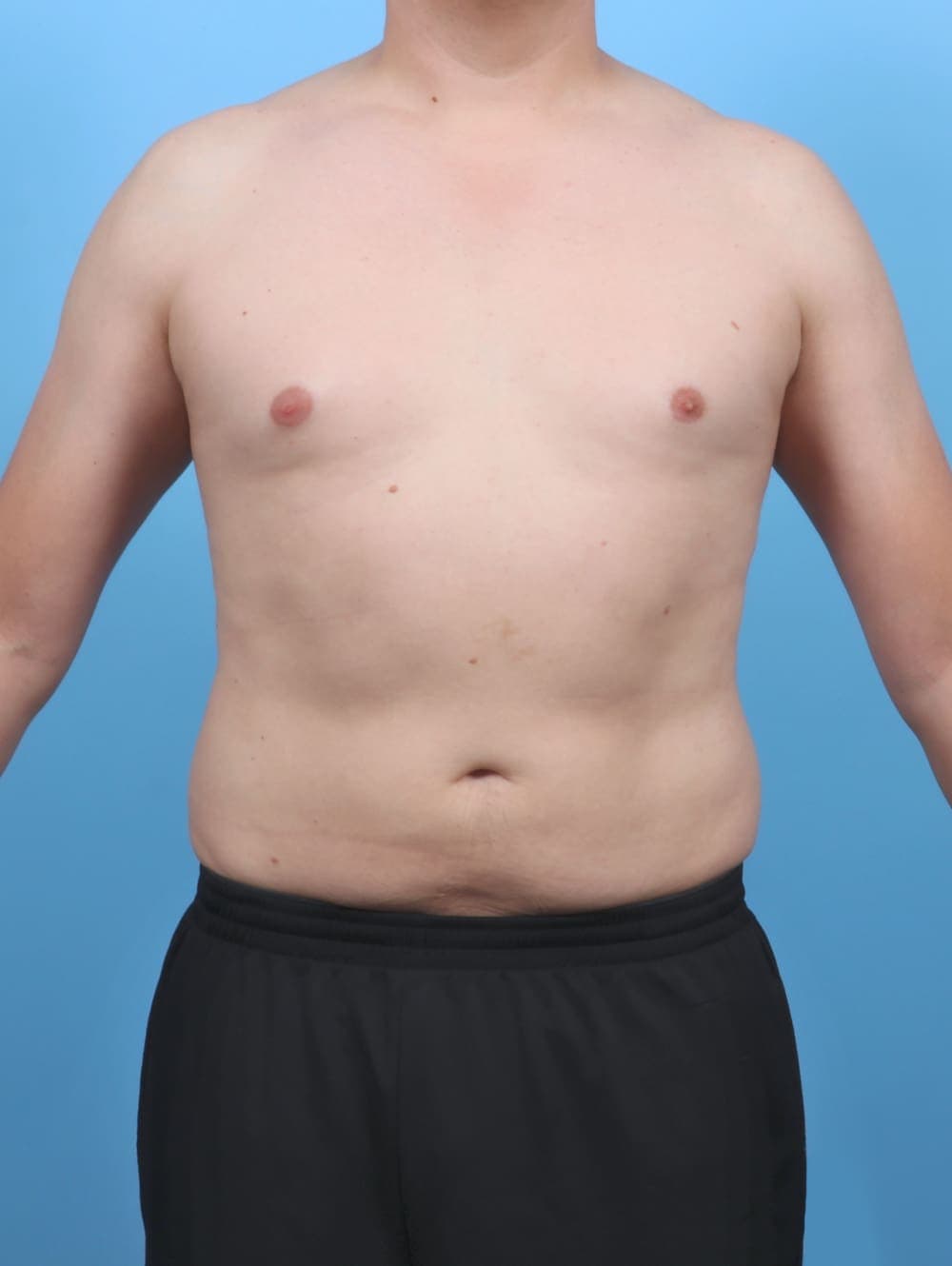 Liposuction case #5992 after, image 1