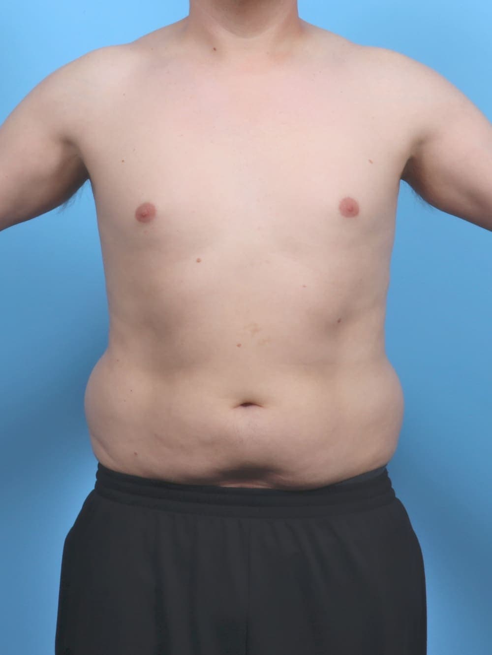 Liposuction case #5992 before, image 1