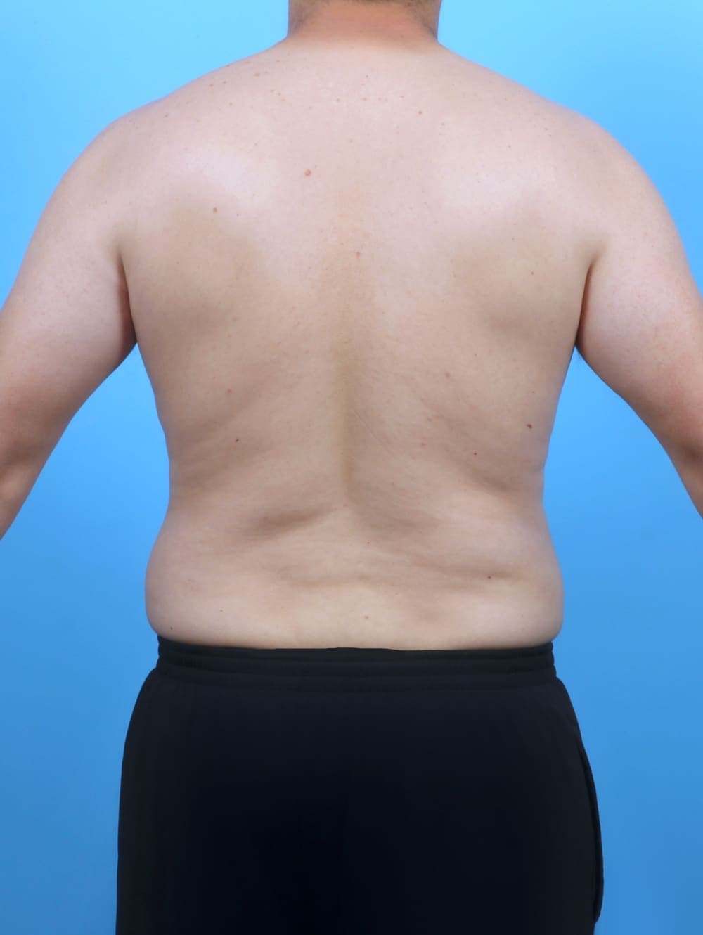 Liposuction case #5992 after, image 4