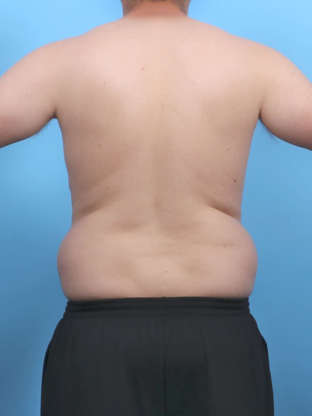 Liposuction case #5992 before, image 4