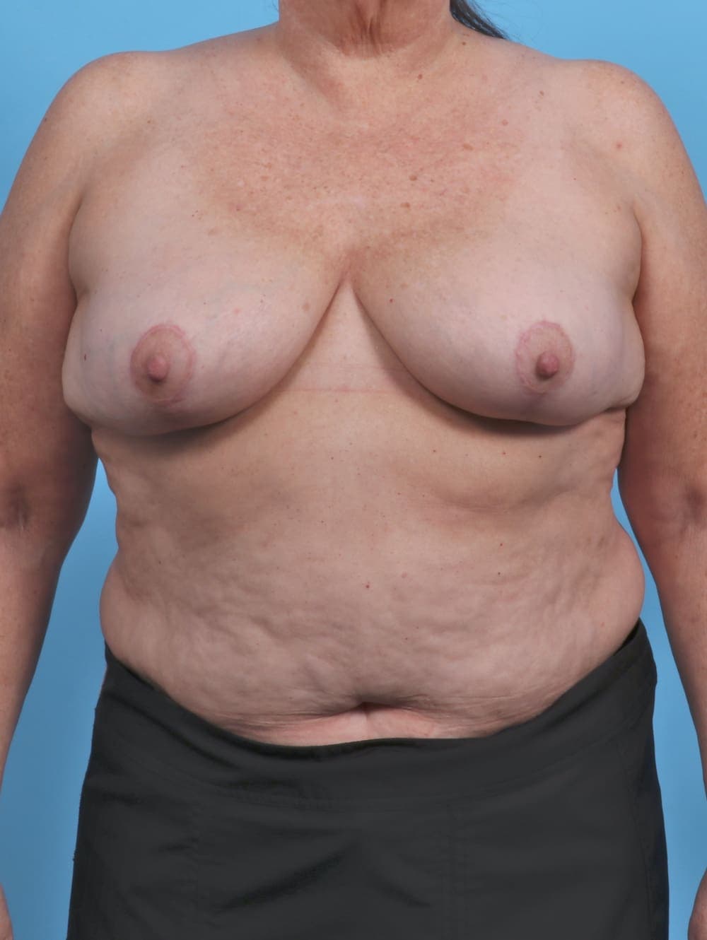 Breast Implant Removal with Lift case #4403 after, image 1