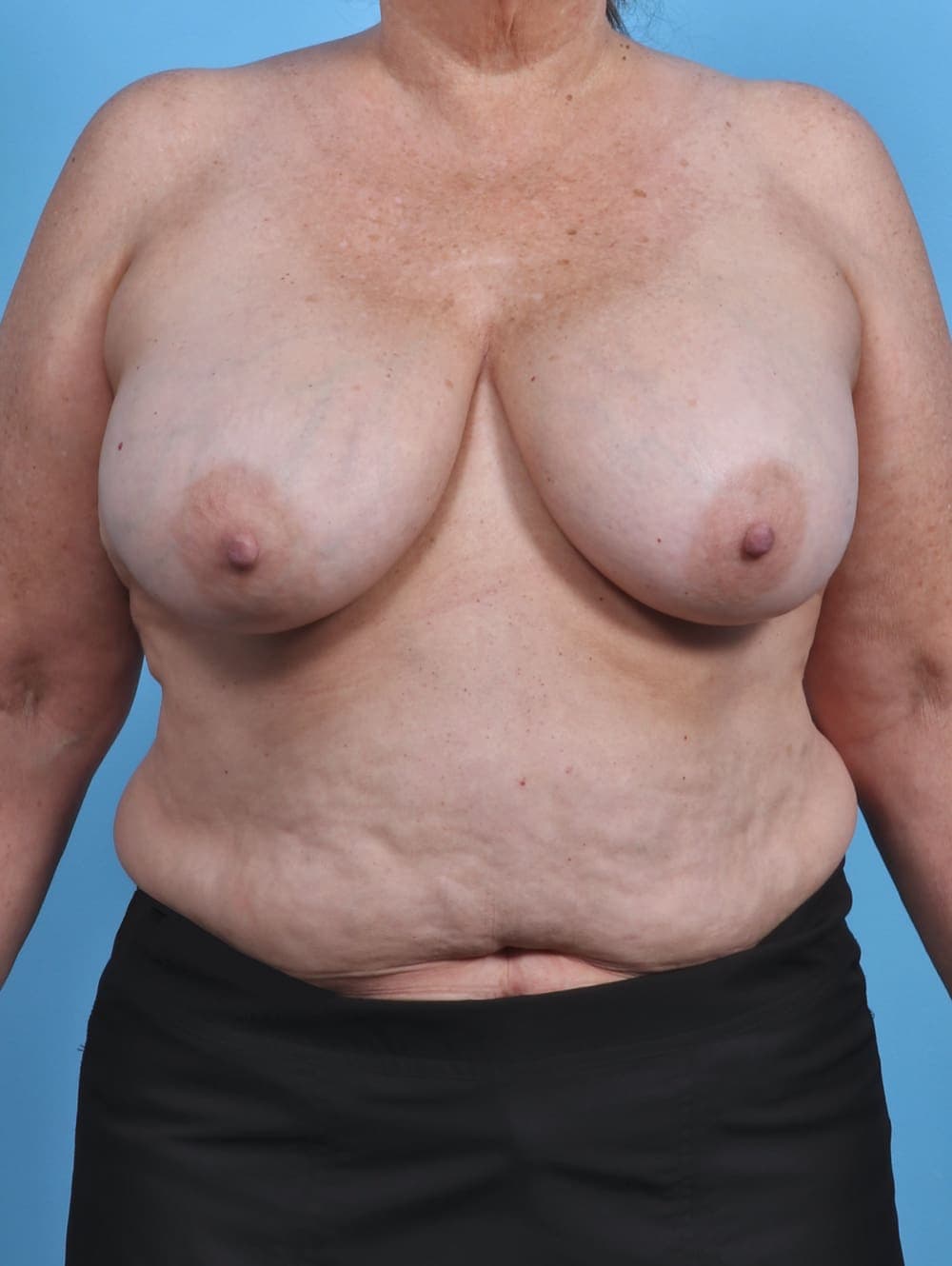 Breast Implant Removal with Lift case #4403 before, image 1