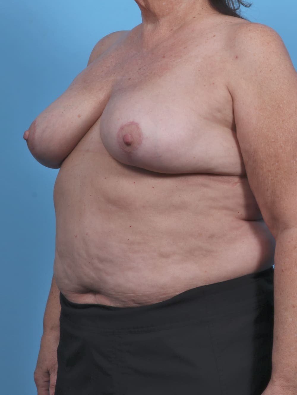 Breast Implant Removal with Lift case #4403 after, image 2