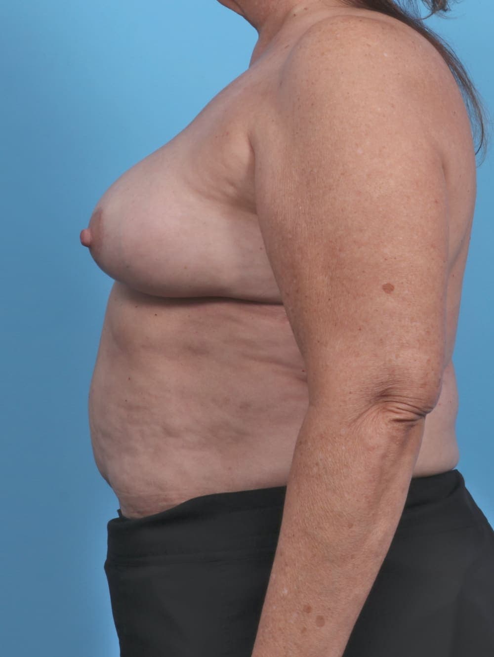 Breast Implant Removal with Lift case #4403 after, image 3