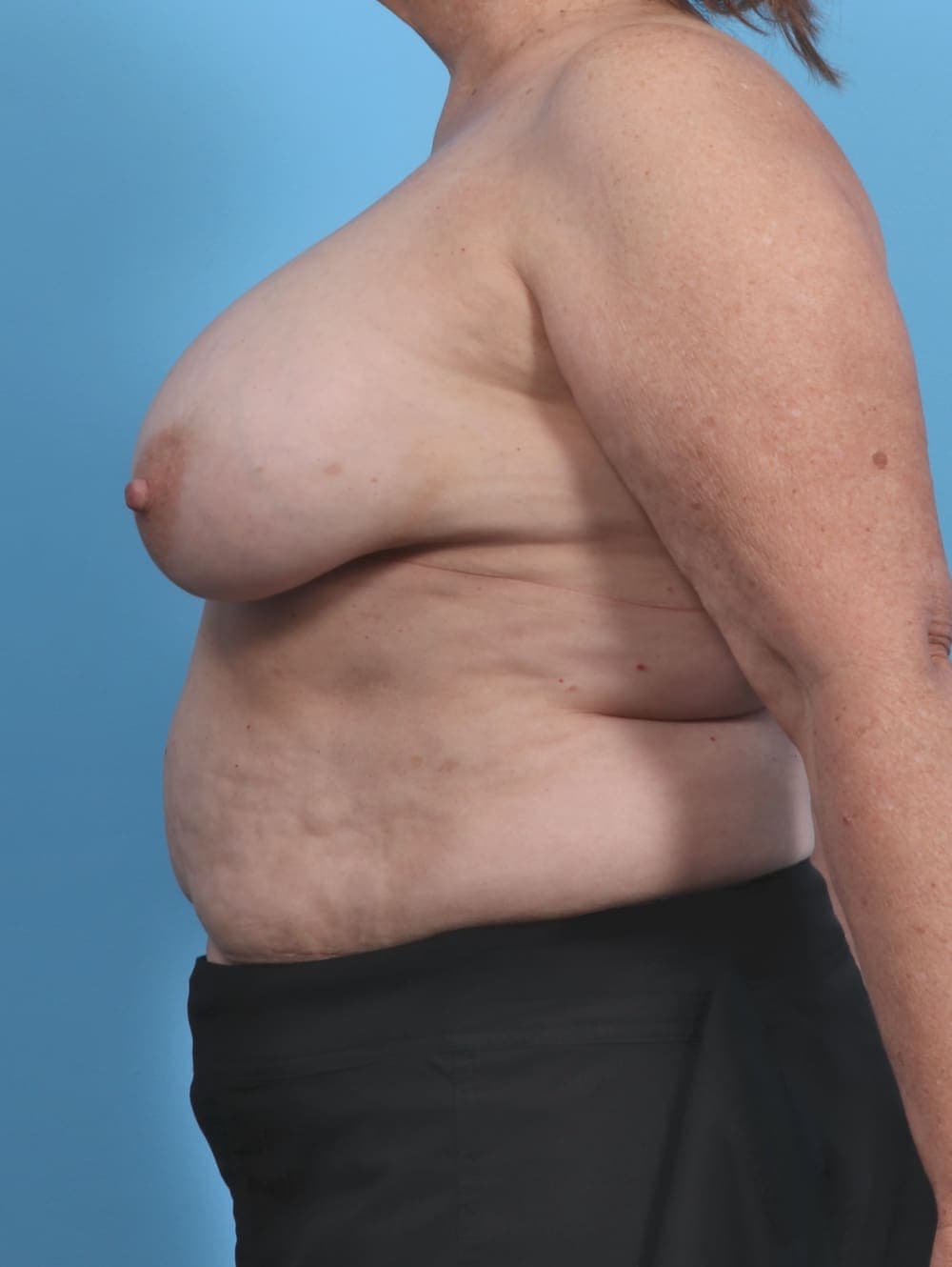 Breast Implant Removal with Lift case #4403 before, image 3
