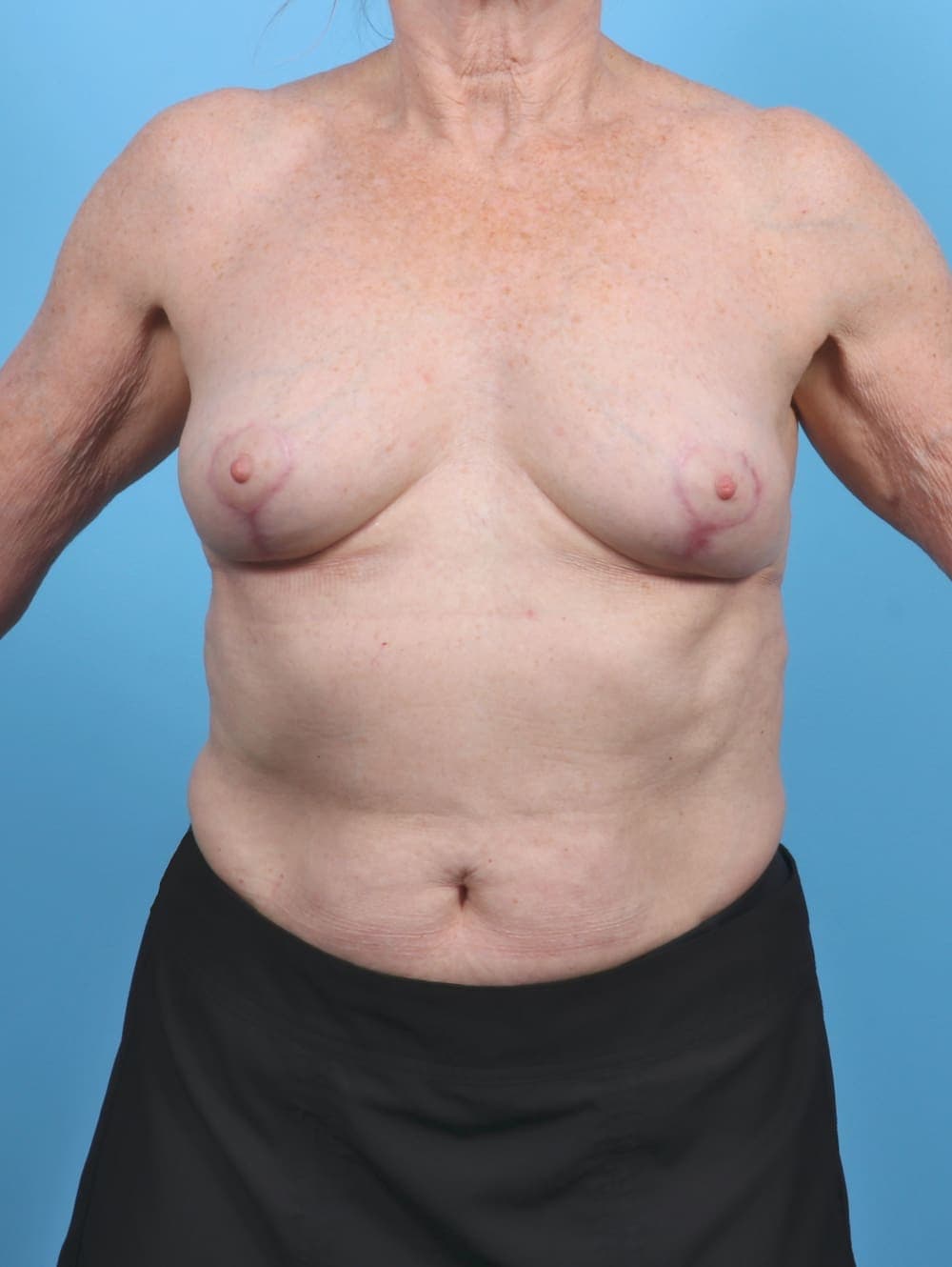 Breast Implant Removal with Lift case #5686 after