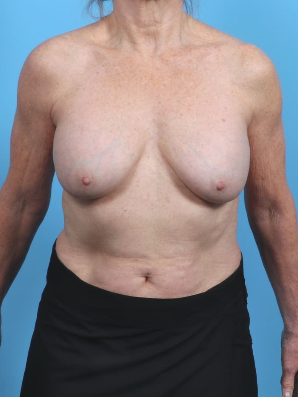 Breast Implant Removal with Lift case #5686 before