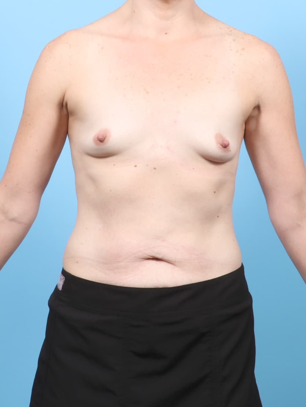 Breast Augmentation case #8626 before