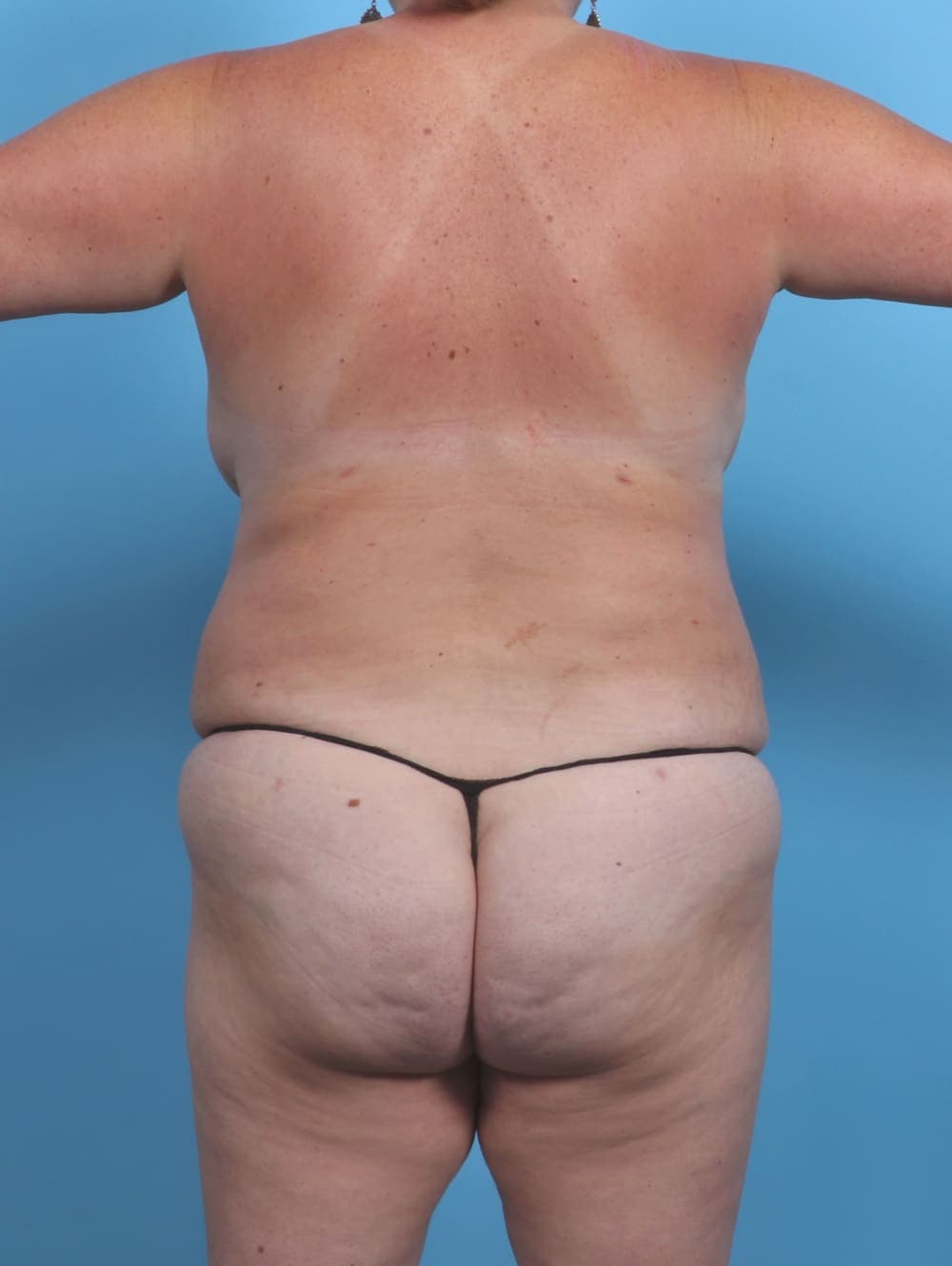 Liposuction case #3991 after, image 2