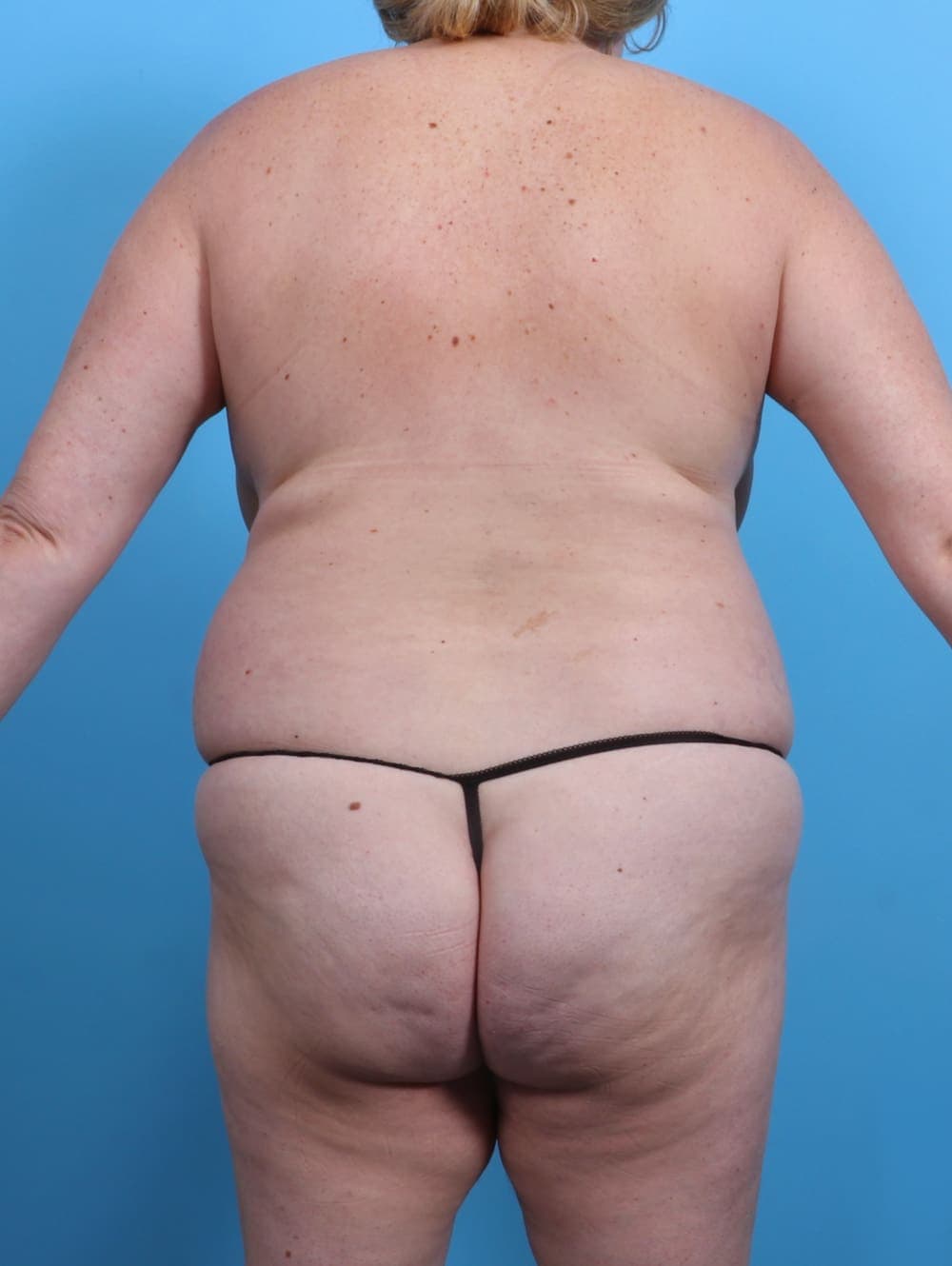 Liposuction case #3991 before, image 2