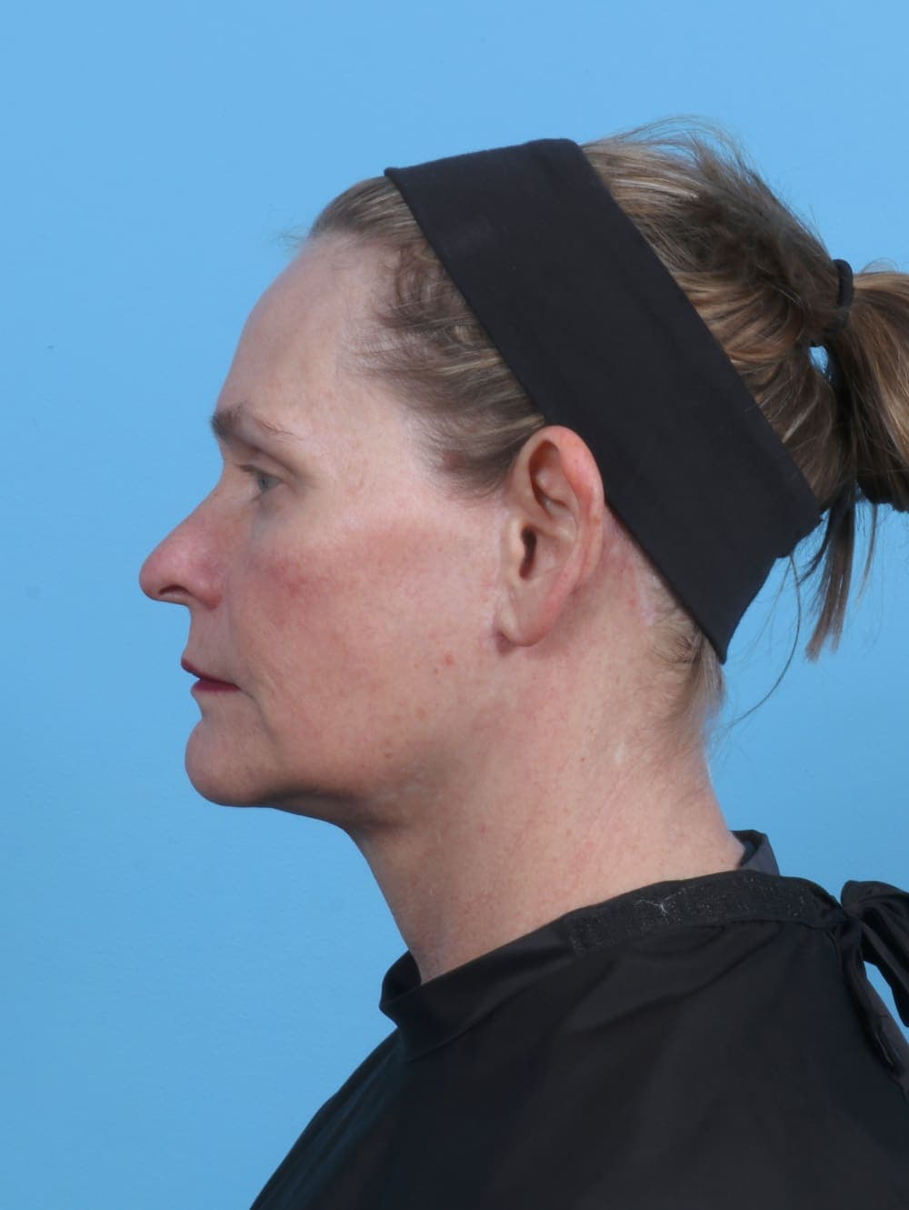 Facelift case #4379 after, image 3