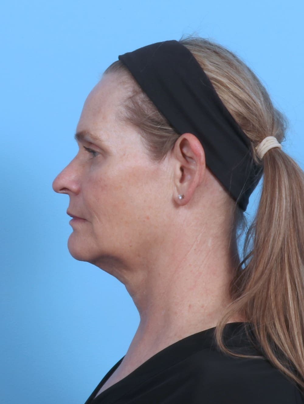 Facelift case #4379 before, image 3