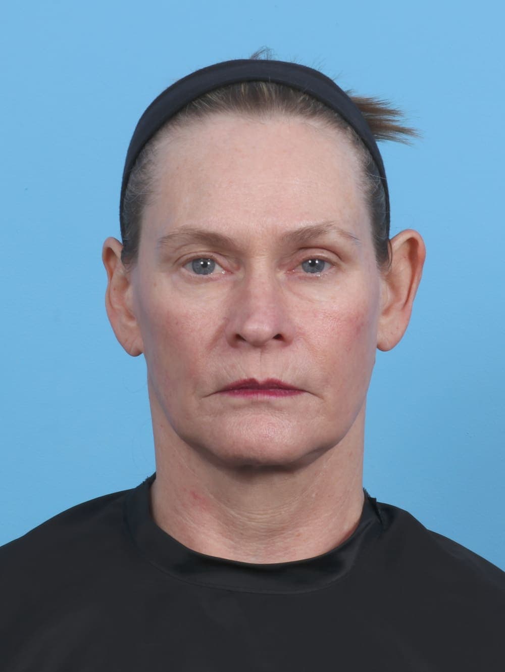 Facelift case #4379 after