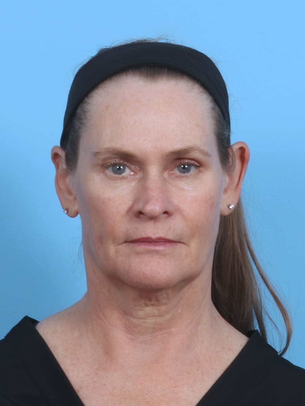 Facelift case #4379 before