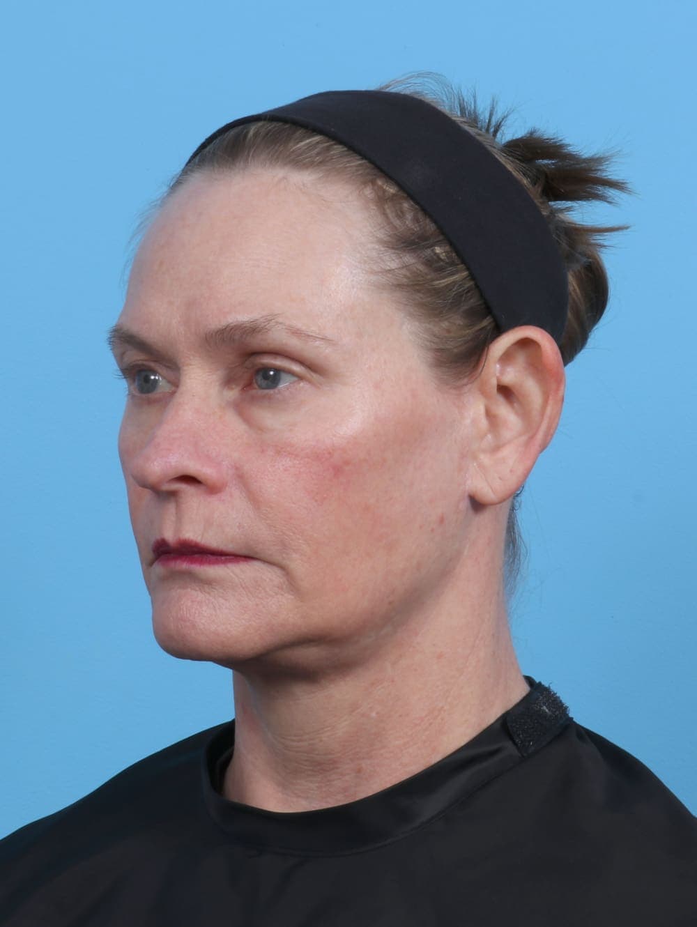 Facelift case #4379 after, image 2