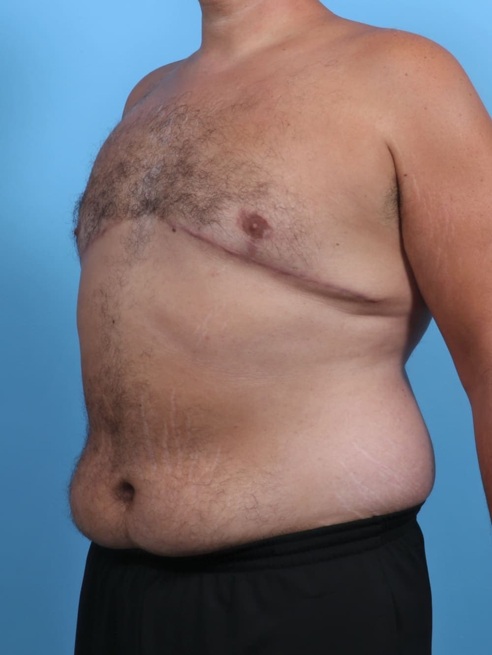 Male Breast Reduction case #3795 after, image 2