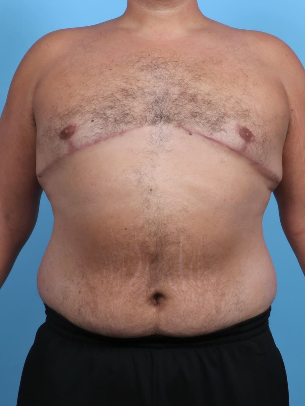 Male Breast Reduction case #3795 after
