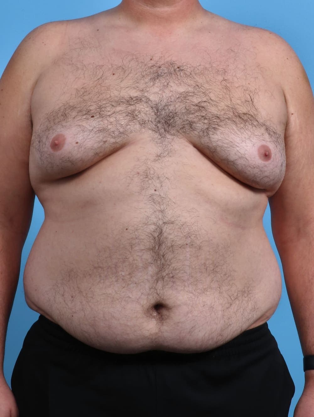 Male Breast Reduction case #3795 before