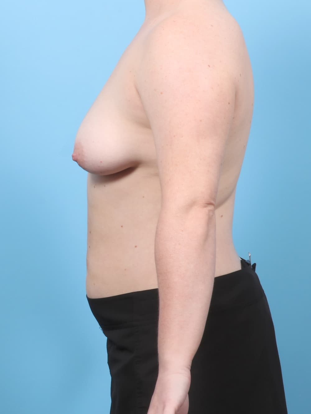 Breast Lift with Implants case #8578 before, image 3