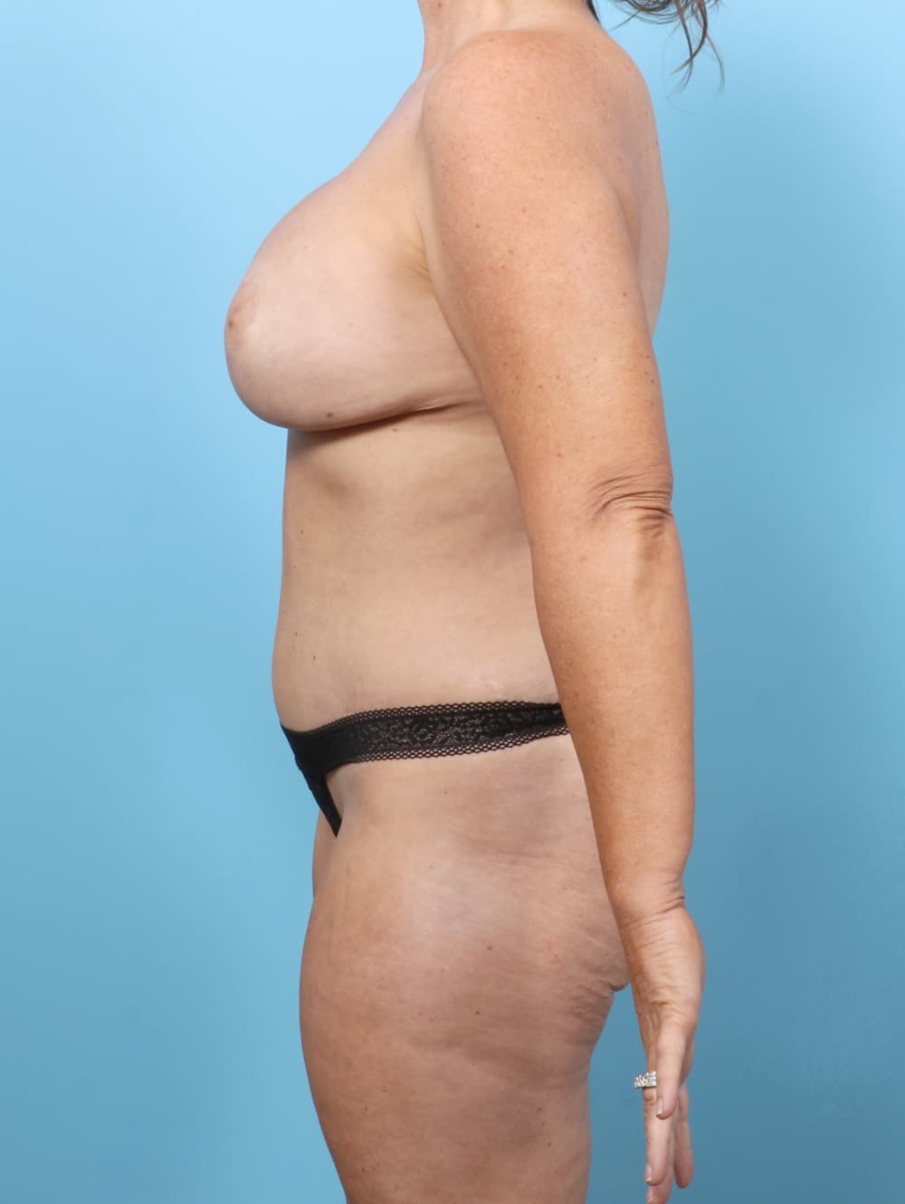 Breast Implant Revision case #8203 after, image 3