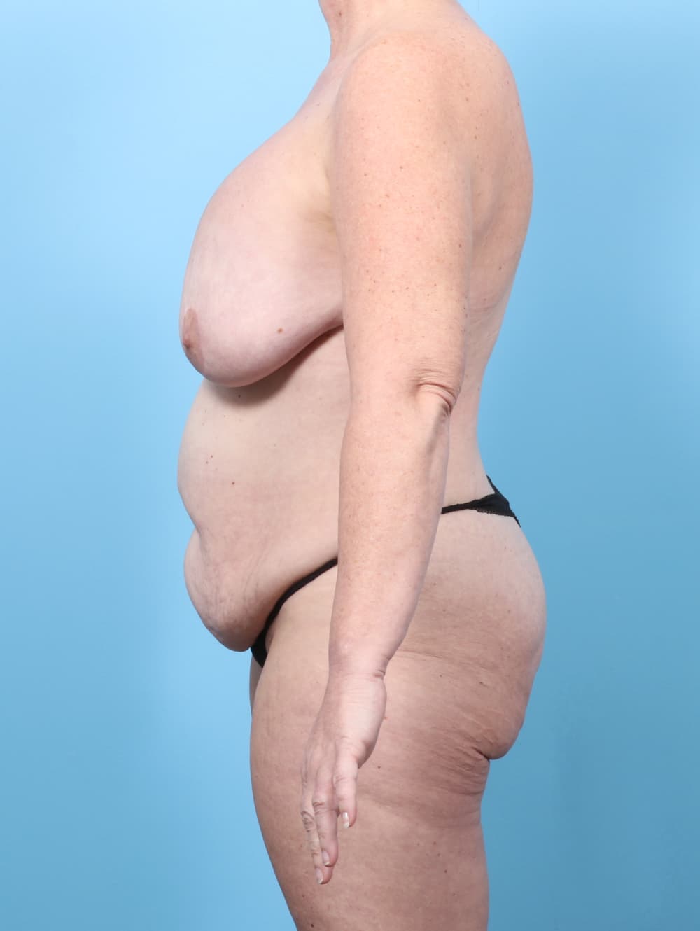 Breast Implant Revision case #8203 before, image 3