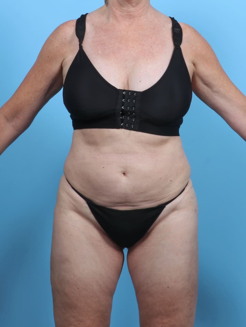Liposuction case #5634 after, image 1