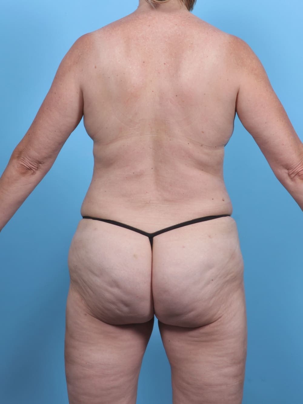 Liposuction case #5634 after, image 2