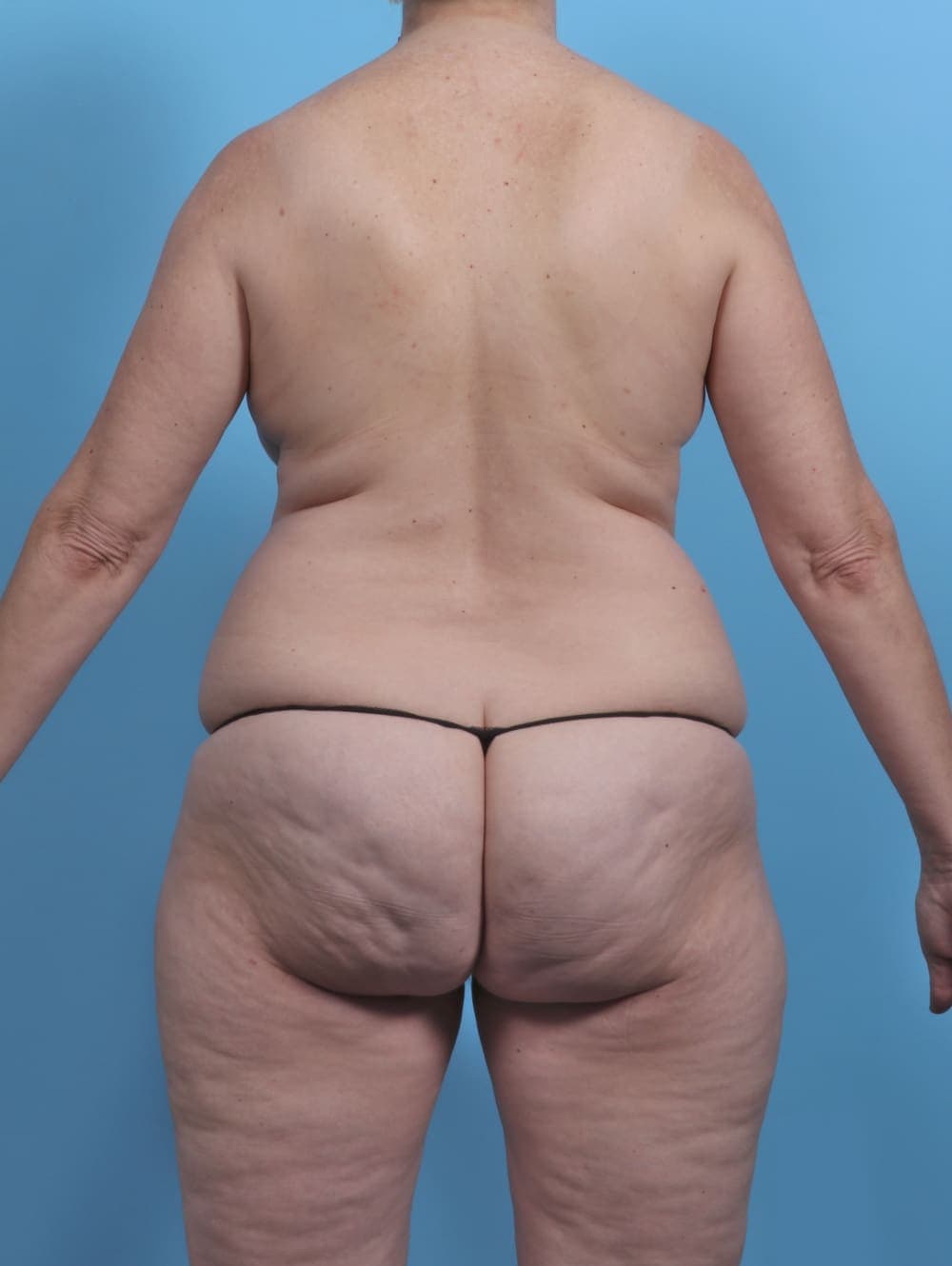 Liposuction case #5634 before, image 2