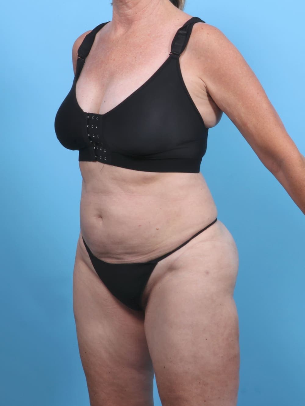 Liposuction case #5634 after, image 3