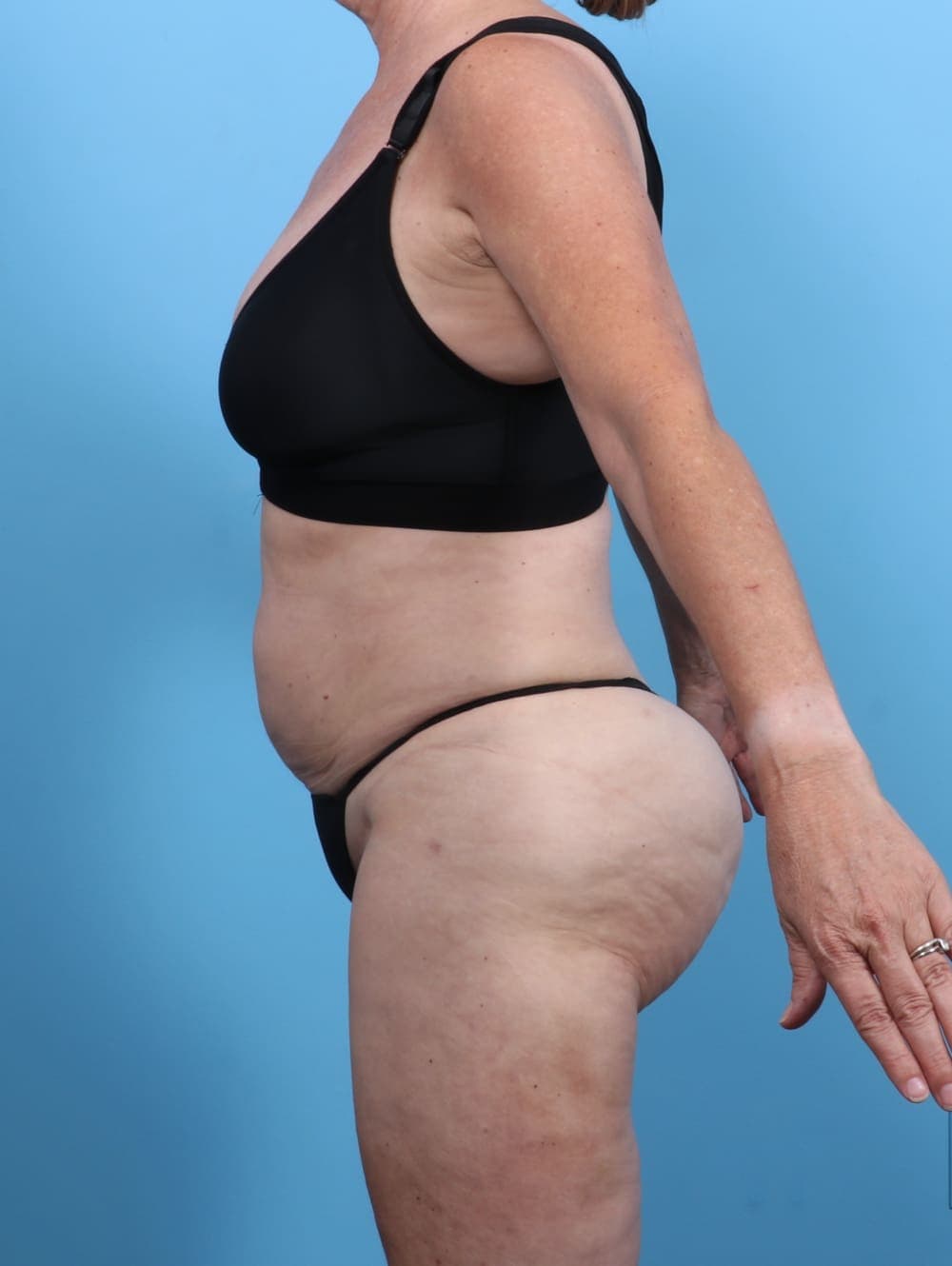 Liposuction case #5634 after, image 4