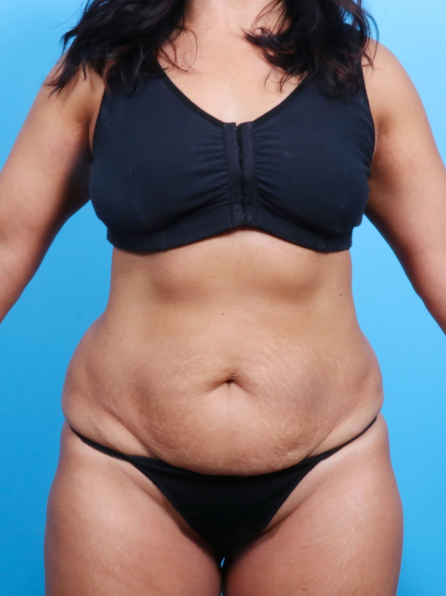 Tummy Tuck case #1526 before, image 1