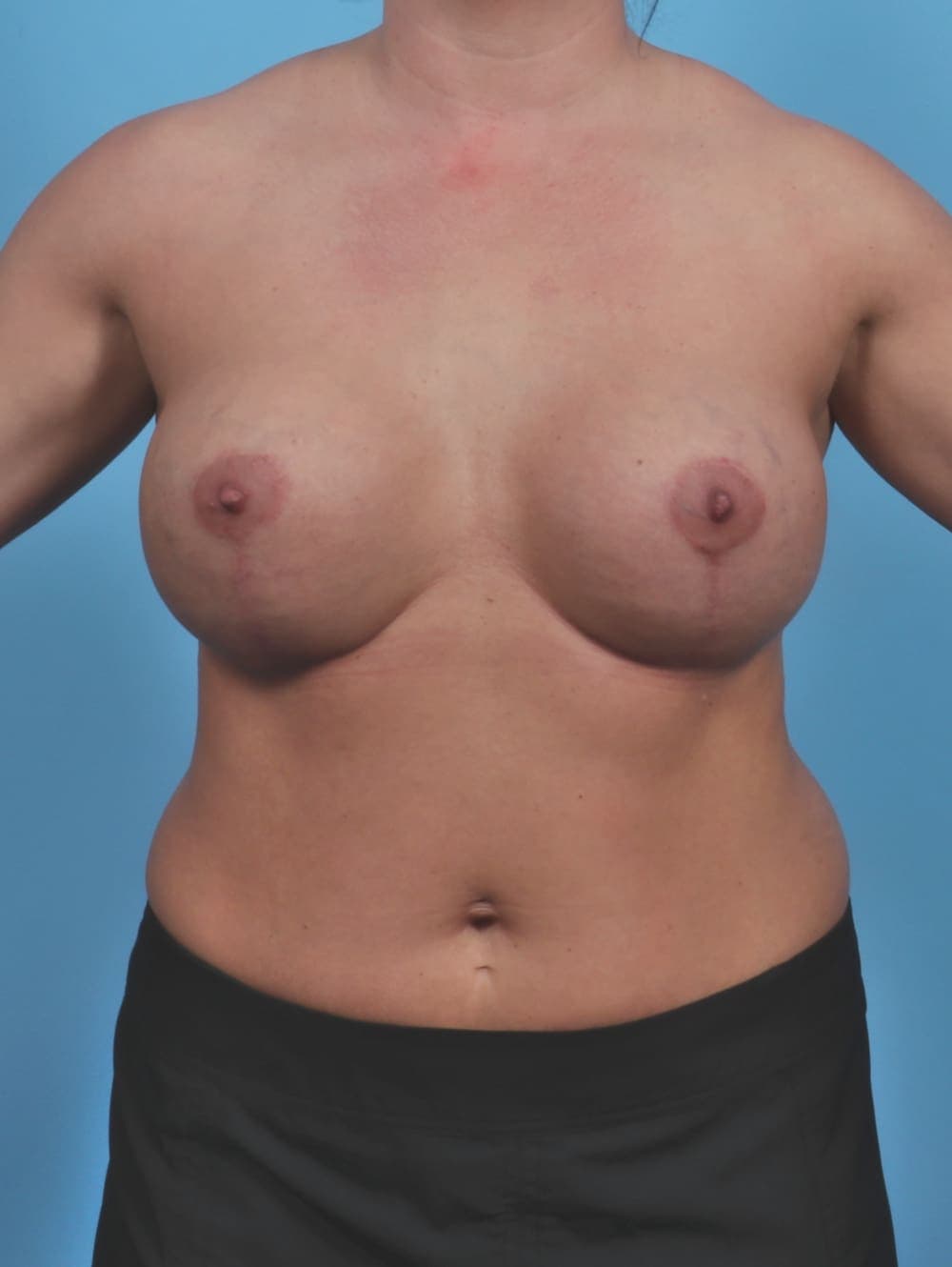 Breast Implant Revision case #4826 after, image 1
