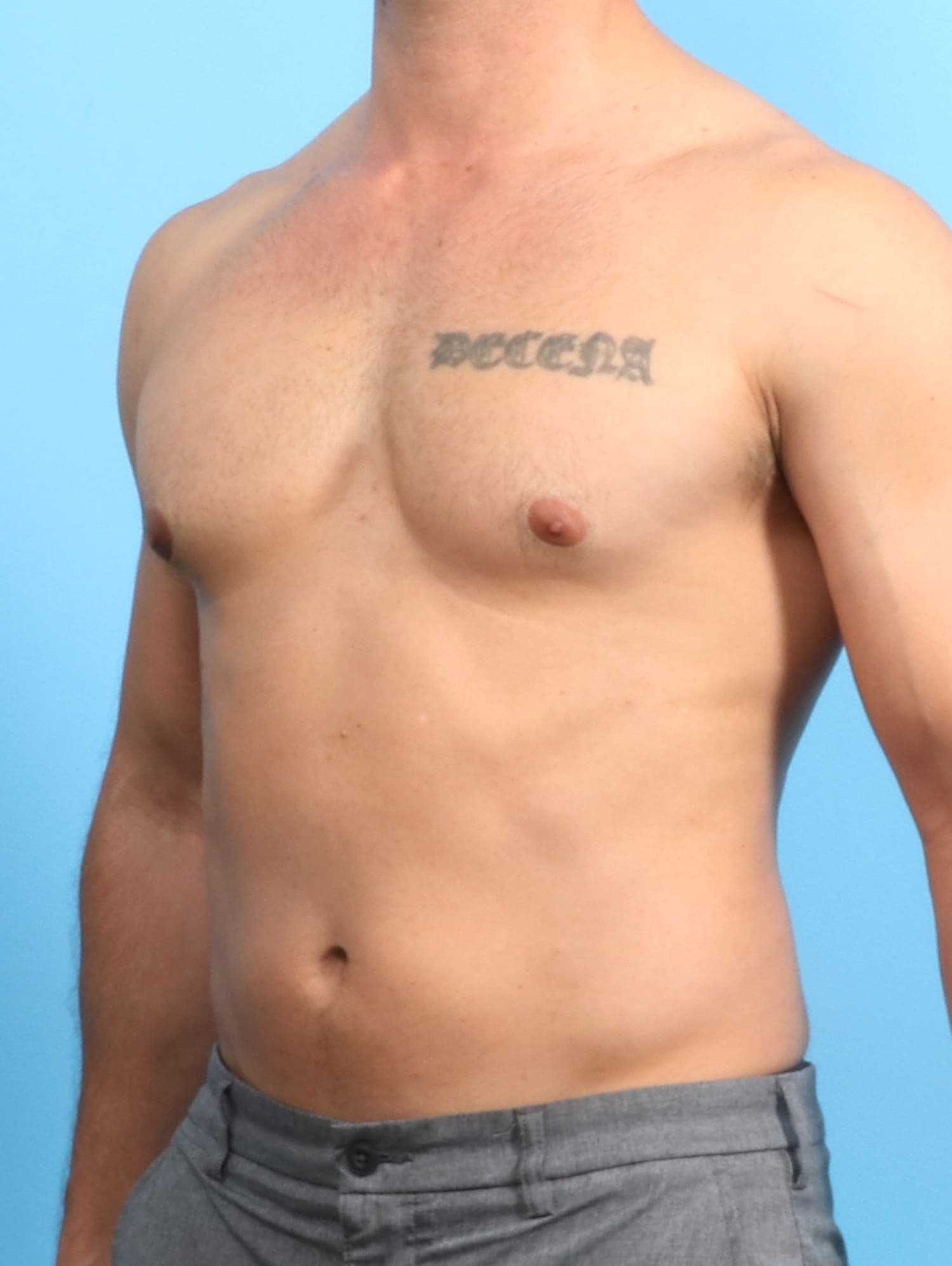 Male Breast Reduction case #1534 after, image 2