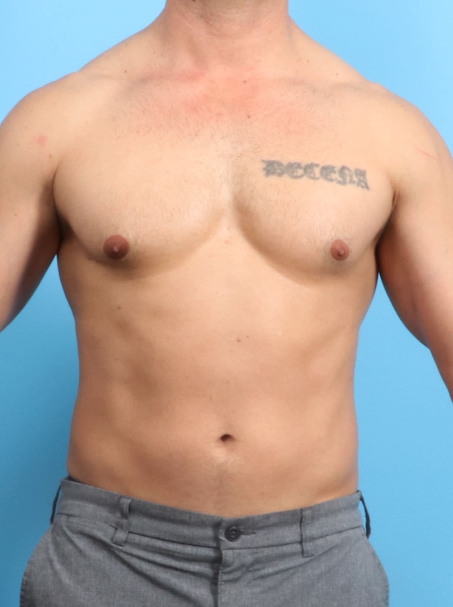 Male Breast Reduction case #1534 after
