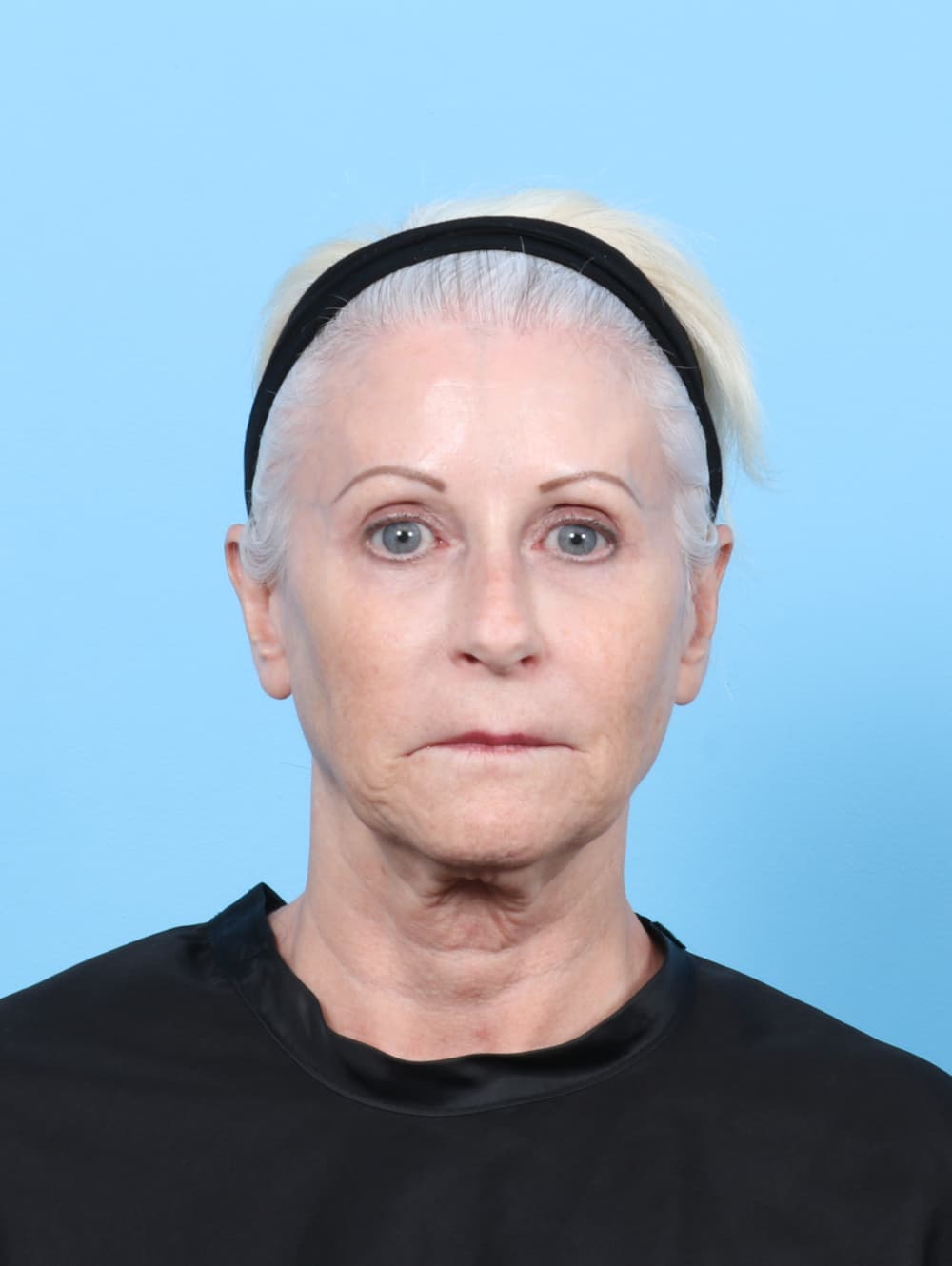 Facelift case #7863 before, image 1