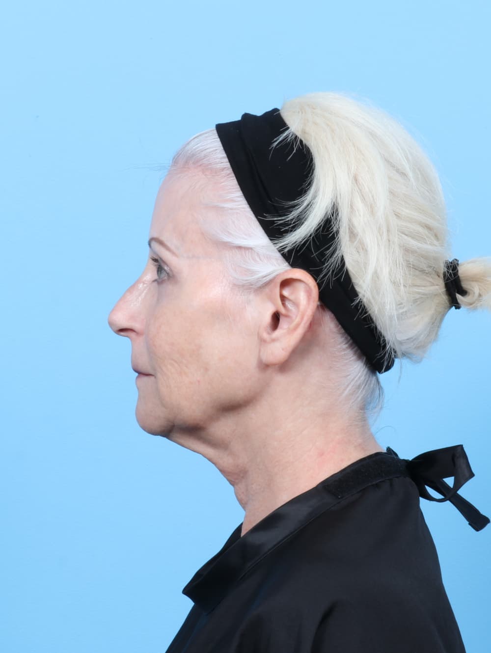 Facelift case #7863 before, image 4