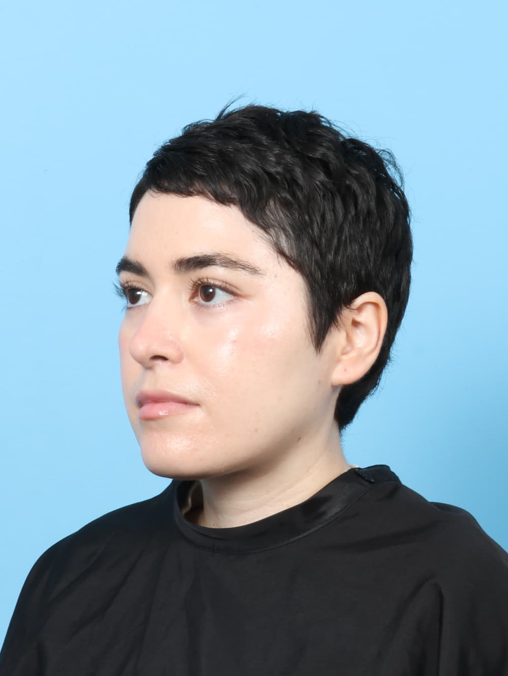 Rhinoplasty case #7668 after, image 3