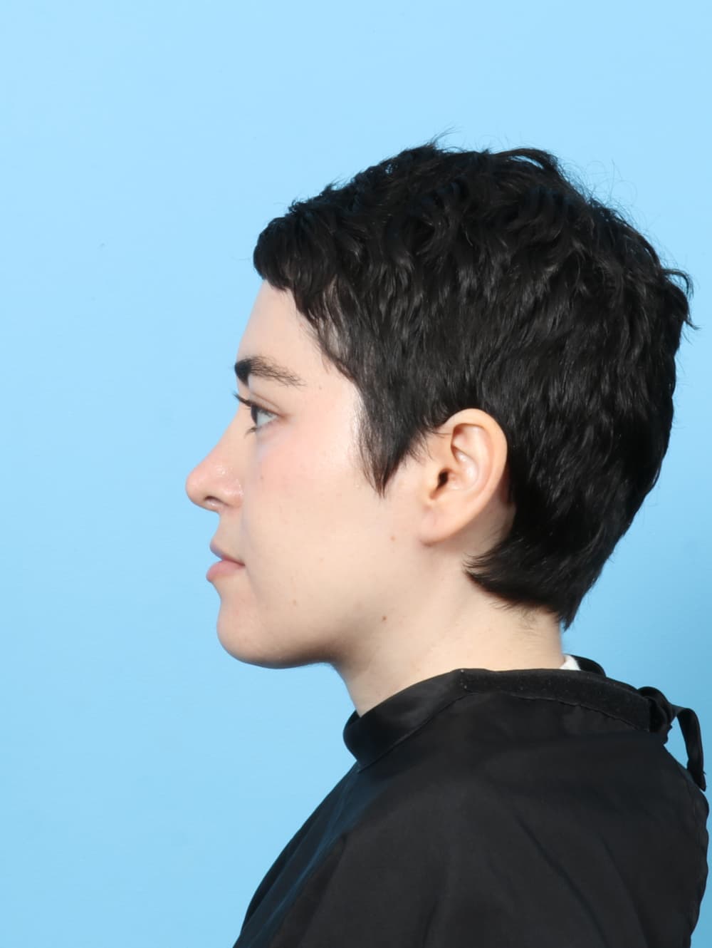 Rhinoplasty case #7668 after, image 1